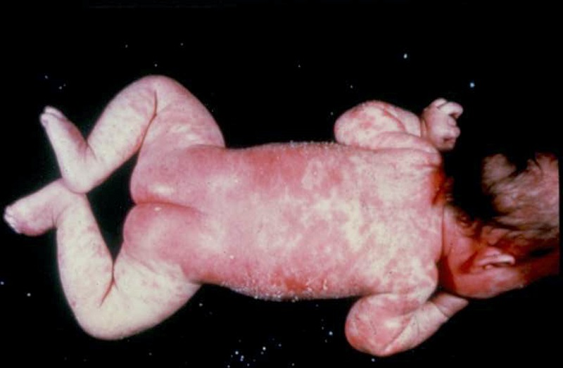 Leiner’s disease là một thể nặng lan tỏa của viêm da dầu ở trẻ em, dẫn đến tình trạng đỏ da bong vảy toàn thân